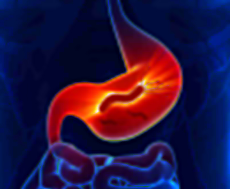 Gastroesophageal Reflux Disease Or GERD GUT BRAIN HEALING With 