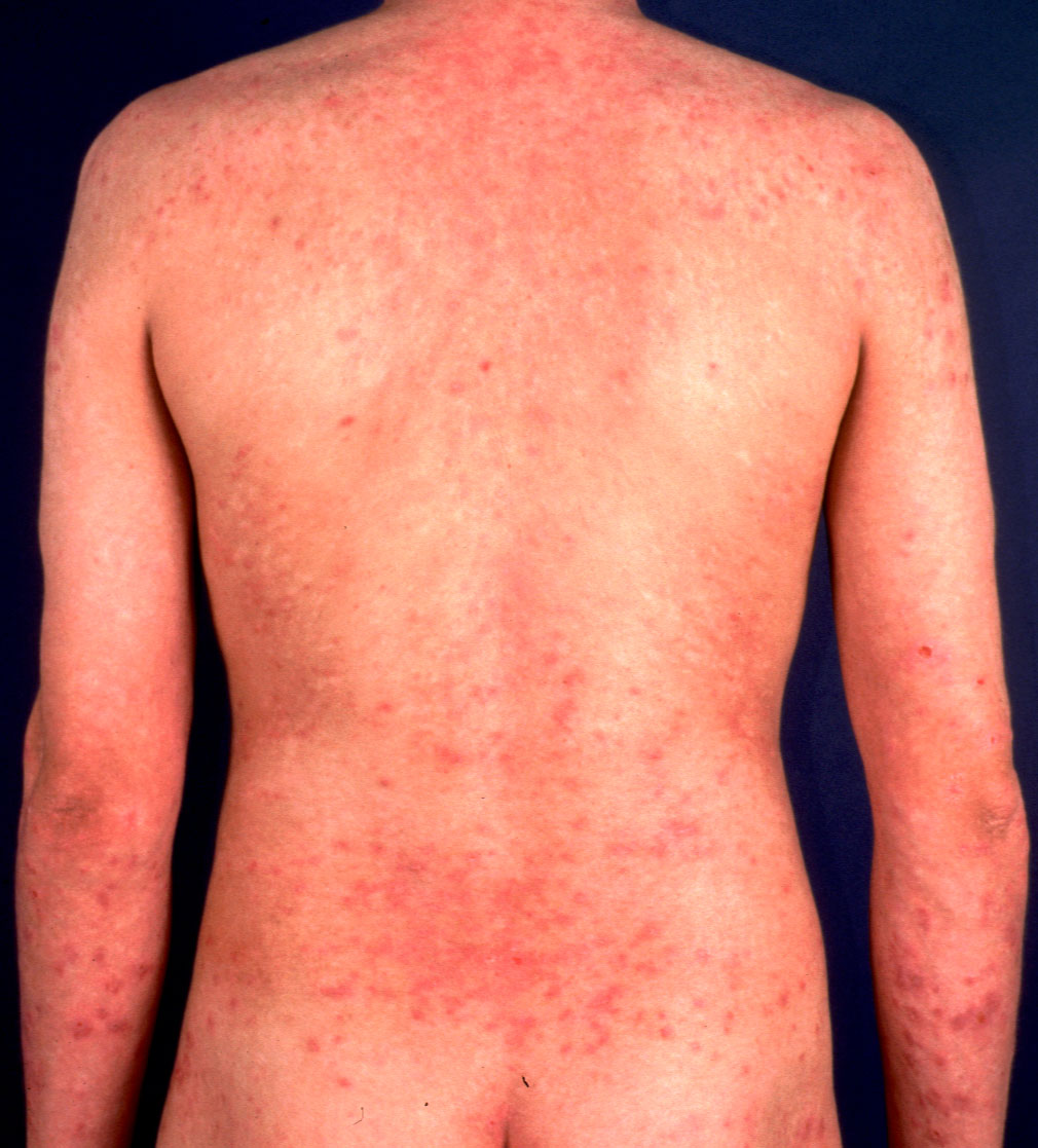allergic-contact-dermatitis